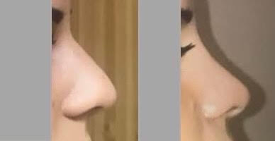 Rhinoplastie : photos avant et après intervention Janvier 2021