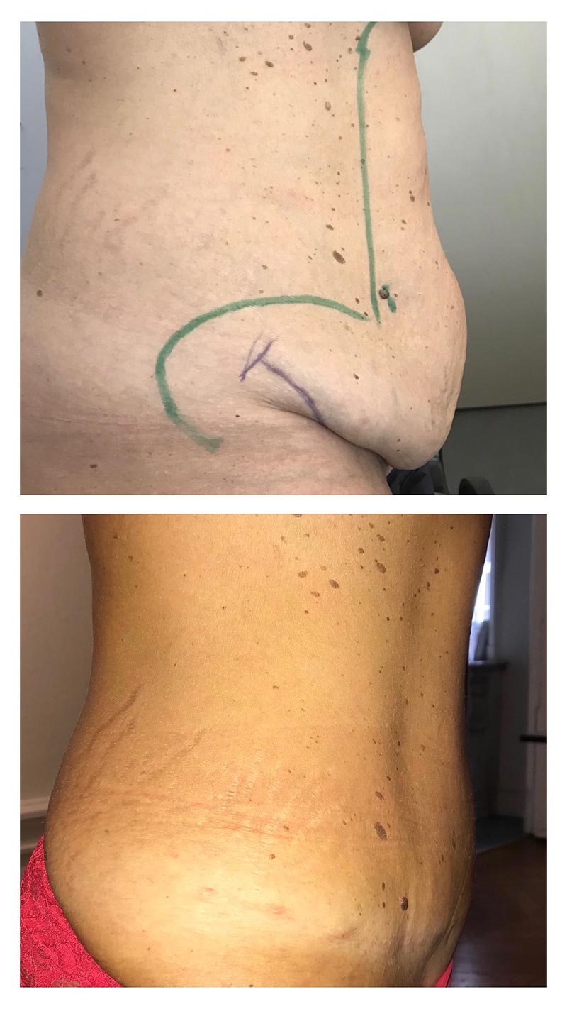 Plastie abdominale avec lipoaspiration ventre et taille