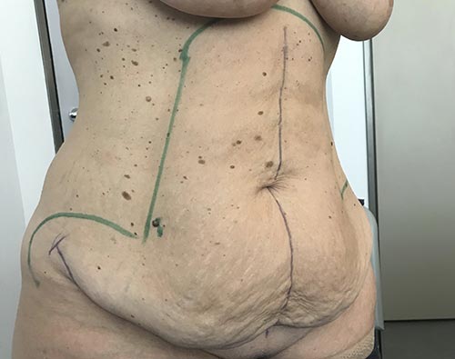 Plastie abdominale avec lipoaspiration ventre et taille