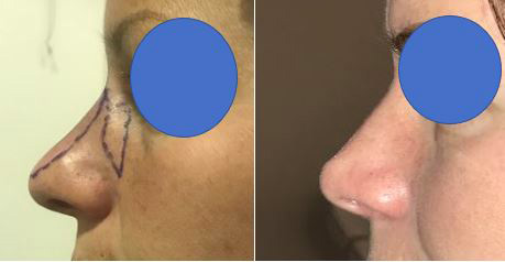 Rhinoplastie : photos avant et après intervention Février 2021