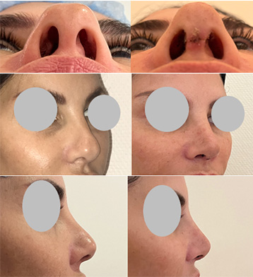 Résultat en photos d'une rhinoplastie