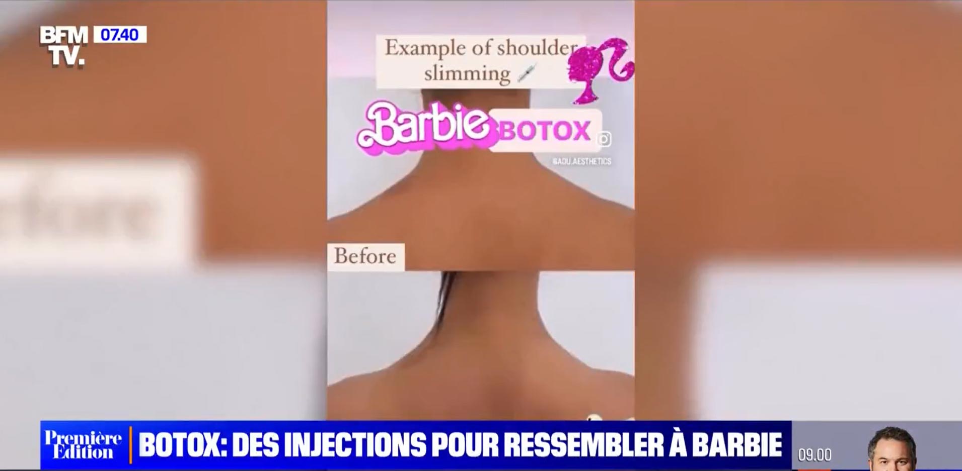 La Barbie-mania, des injections pour ressembler à Barbie