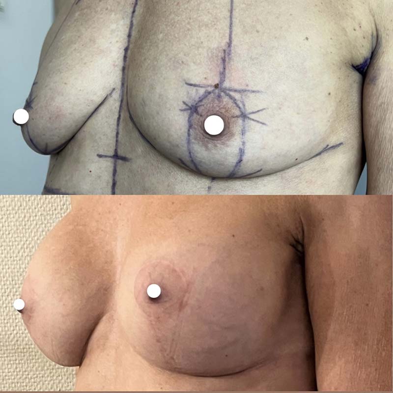 Lifting des seins avec pose d'implants mammaires pour ptose avec hypotrophie