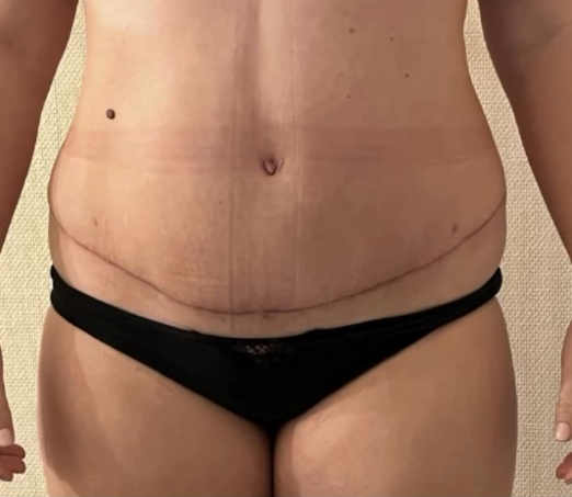 Plastie abdominale avec lipoaspiration du ventre pour forte détérioration de la paroi cutanée et musculaire