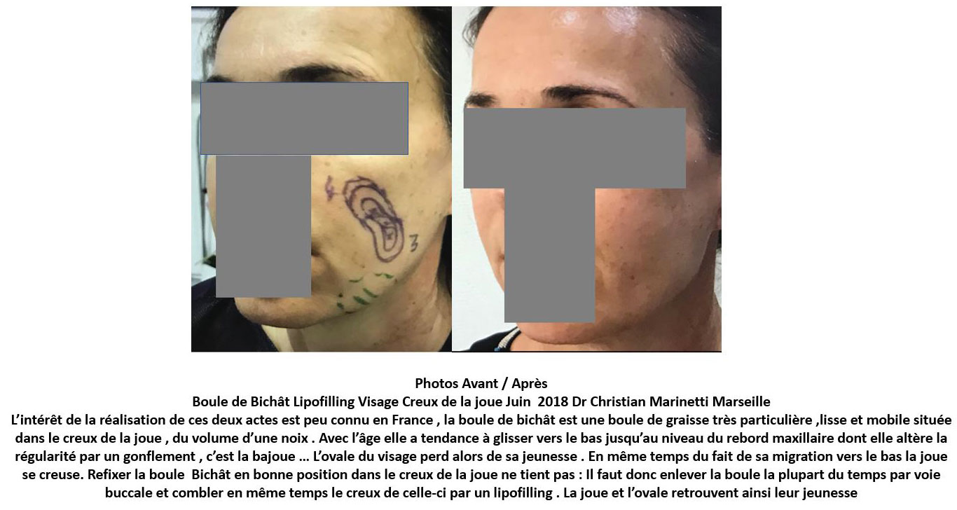 Lipofilling du visage