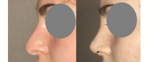 Rhinoplastie