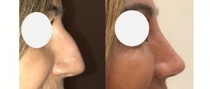 Rhinoplastie