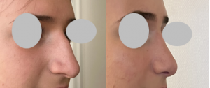 Rhinoplastie