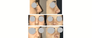 Rhinoplastie