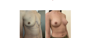 Chirurgie mammaire : implants, lifting des seins, lipofilling mammaire 