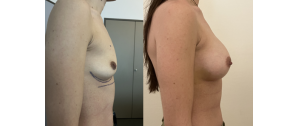 Chirurgie mammaire : implants, lifting des seins, lipofilling mammaire 