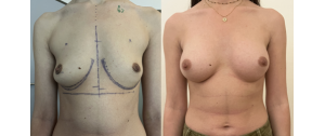 Chirurgie mammaire : implants, lifting des seins, lipofilling mammaire 