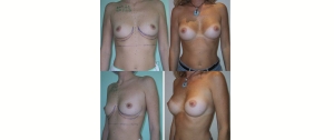 Chirurgie mammaire : implants, lifting des seins, lipofilling mammaire 