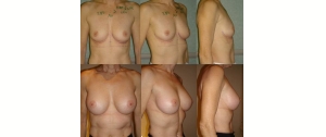 Chirurgie mammaire : implants, lifting des seins, lipofilling mammaire 