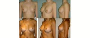 Chirurgie mammaire : implants, lifting des seins, lipofilling mammaire 