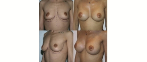 Chirurgie mammaire : implants, lifting des seins, lipofilling mammaire 