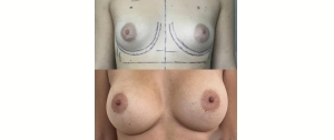 Chirurgie mammaire : implants, lifting des seins, lipofilling mammaire 