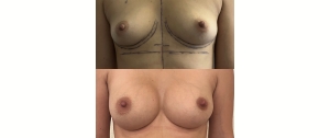 Chirurgie mammaire : implants, lifting des seins, lipofilling mammaire 