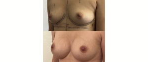 Chirurgie mammaire : implants, lifting des seins, lipofilling mammaire 