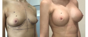 Chirurgie mammaire : implants, lifting des seins, lipofilling mammaire 