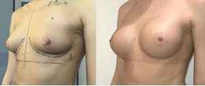 Chirurgie mammaire : implants, lifting des seins, lipofilling mammaire 