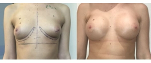 Chirurgie mammaire : implants, lifting des seins, lipofilling mammaire 