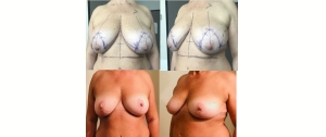 Chirurgie mammaire : implants, lifting des seins, lipofilling mammaire 