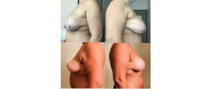 Chirurgie mammaire : implants, lifting des seins, lipofilling mammaire 