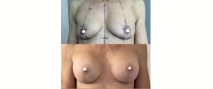 Chirurgie mammaire : implants, lifting des seins, lipofilling mammaire 