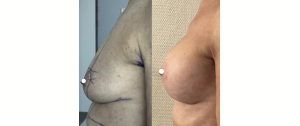 Chirurgie mammaire : implants, lifting des seins, lipofilling mammaire 