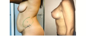 Chirurgie mammaire : implants, lifting des seins, lipofilling mammaire 