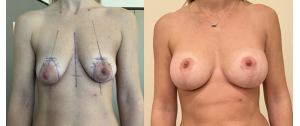 Chirurgie mammaire : implants, lifting des seins, lipofilling mammaire 