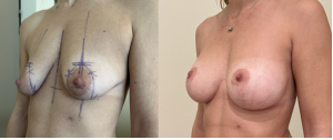 Chirurgie mammaire : implants, lifting des seins, lipofilling mammaire 