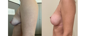 Chirurgie mammaire : implants, lifting des seins, lipofilling mammaire 