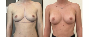 Chirurgie mammaire : implants, lifting des seins, lipofilling mammaire 