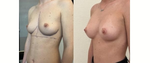 Chirurgie mammaire : implants, lifting des seins, lipofilling mammaire 