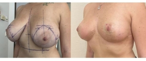 Chirurgie mammaire : implants, lifting des seins, lipofilling mammaire 