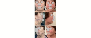 Chirurgie plastique du visage