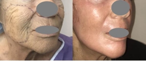 Chirurgie plastique du visage