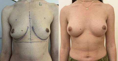 Implants mammaires anatomiques rétro-musculaires sans cicatrices sur les seins