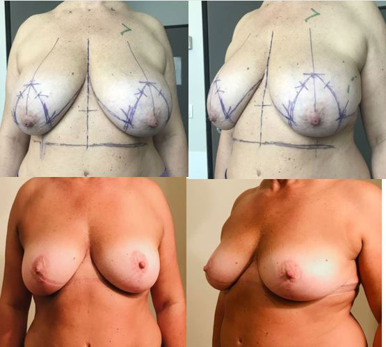 Lifting des seins avec réduction de volume