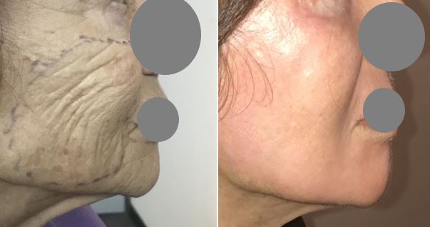 Traitement des rides du visage par peeling profond au phénol dr marinetti