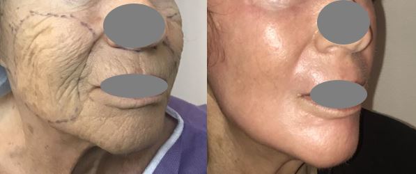 Traitement des rides du visage par peeling profond au phénol dr marinetti