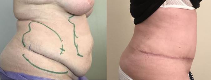 Plastie abdominale avec lipoaspiration au premier mois post opératoire dr marinetti avril 2021