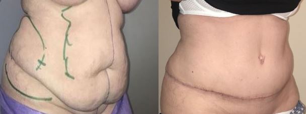 Plastie abdominale avec lipoaspiration au premier mois post opératoire dr marinetti avril 2021