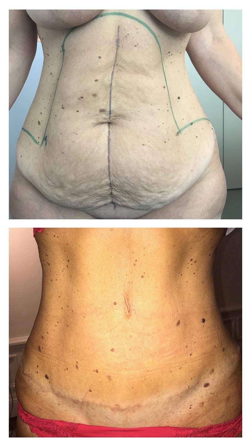 Plastie abdominale avec lipoaspiration ventre et taille