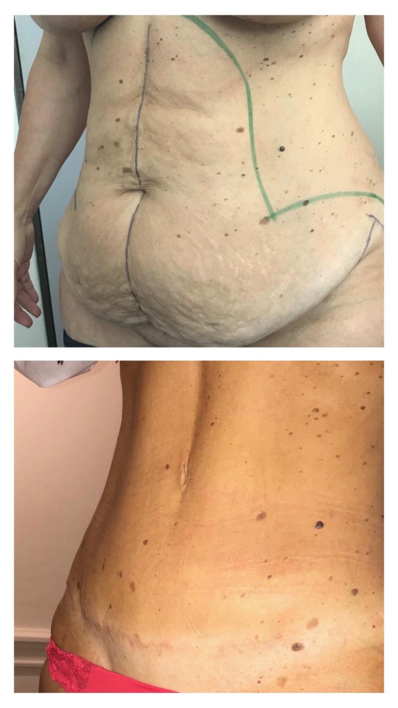 Plastie abdominale avec lipoaspiration ventre et taille