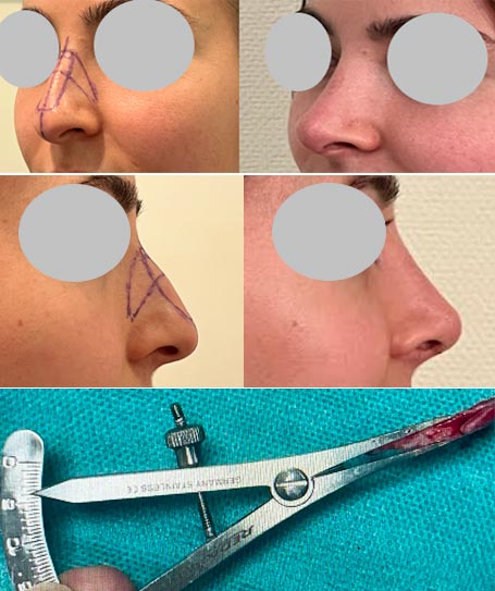 Rhinoplastie pour malformation et gêne fonctionnelle à 1 mois post-opératoire