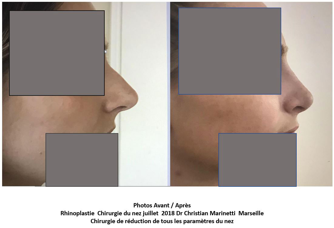 rhinoplastie marseille du docteur marinetti