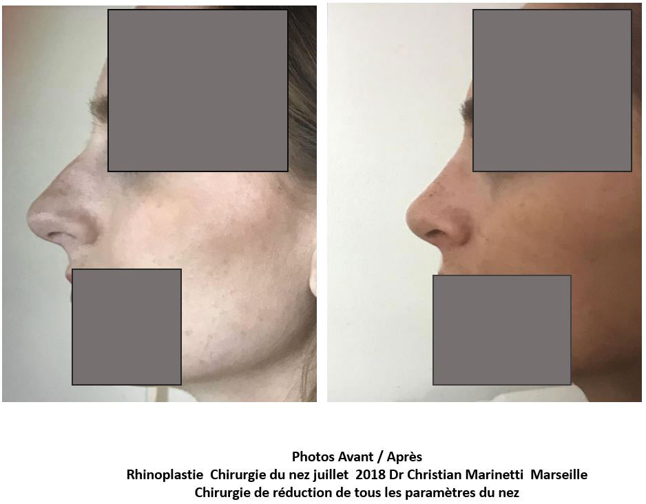 rhinoplastie marseille docteur marinetti